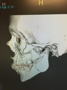 X-ray of Alex Cintron's jaw following his 2014 spill.